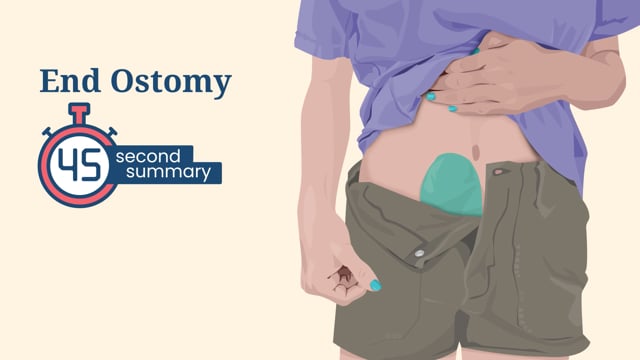 45 Second Summary: End Ostomy