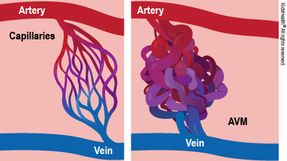Diagram showing an artery and vein connected by capillaries and an artery and vein with an arterial venous malformation (AVM) in the connection.