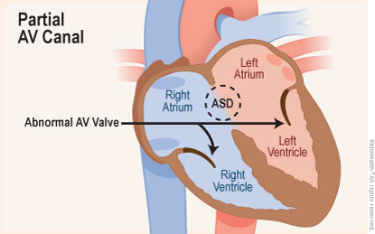 Diagram of partial atrioventricular canal shows right atrium and right ventricle, left ventricle, left atrium, ASD, and abnormal atrioventricular valve. 