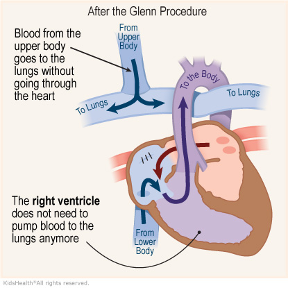 Illustration: How blood flows after the Glenn Procedure