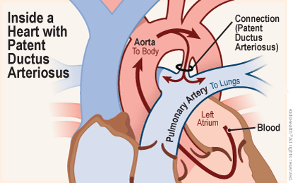Close-up diagram of the heart with patent ductus arteriosus — a connection between the aorta and pulmonary artery leading from the heart. The connection is a normal part of a baby's circulatory system in the womb, however it usually closes shortly after birth.