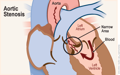 Diagram of a cross-section of the heart shows aortic stenosis — when a narrow area develops in the aortic valve. Blood flows from the left atrium into the left ventricle, but then is reduced or blocked as it tries to pass through the valve into the aorta.