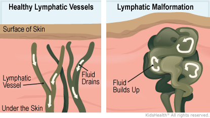 Illustration: Lymphatic Malformation