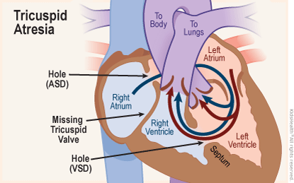 Cross section diagram of the heart shows tricuspid atresia — a congential defect where the tricuspid valve is missing plus there are two holes in the septum (one ASD and one VSD) resulting in misdirected blood flow.