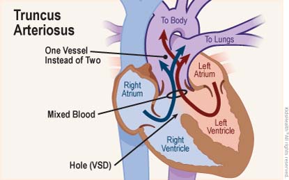 Cross section diagram of the heart shows truncus arteriosus — a birth defect where only one blood vessel comes out of the heart (instead of two, the aorta and the pulmonary artery) and a hole (VSD) together allow mixed blood to leave the heart.