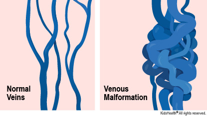 Diagram showing normal veins and the larger, more tangled veins that happen with a venous malformation.