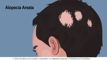 Alopecia aerata 