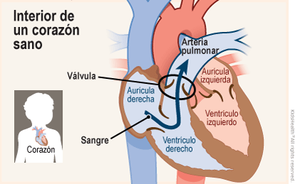 Se muestran dos ilustraciones. Una muestra la posición del corazón en el cuerpo y la otra un primer plano de un corte transversal de un corazón sano. La sangre fluye desde la aurícula derecha hacia el ventrículo derecho y, a través de una válvula, llega a la arteria pulmonar. 