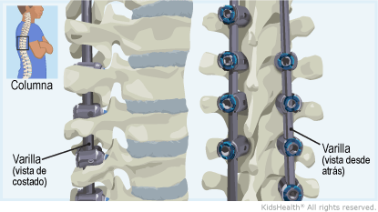 Se muestran tres ilustraciones. Una ilustración muestra la posición de la columna vertebral en el cuerpo de una persona. Las otras dos ilustraciones muestran la posición de las varillas en la columna vertebral; una ilustracion muestra una vista de costado y la otra desde atrás.