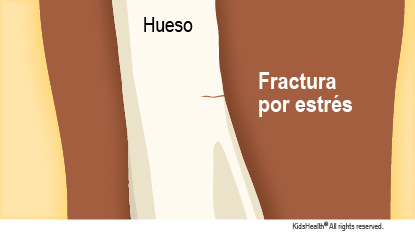 Se muestra un hueso con una pequeña fractura por sobrecarga.