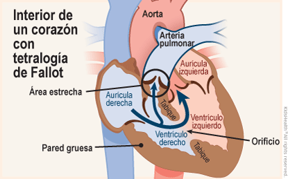 Se muestra un corte transversal del corazón con tetralogía de Fallot; un defecto congénito crítico que presenta cuatro problemas.  Primer problema: un orificio en el tabique entre los ventrículos que afecta el flujo sanguíneo normal; segundo problema: estrechamiento en el paso del corazón a los pulmones; tercer problema: la aorta está sobre el orificio de los ventrículos; cuarto problema: el músculo que rodea el ventrículo derecho se vuelve demasiado grueso